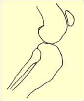 Cranial Cruciate Disease