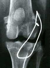 Knee Surgery